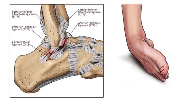 التواء الكاحل وتمزق الأربطة
